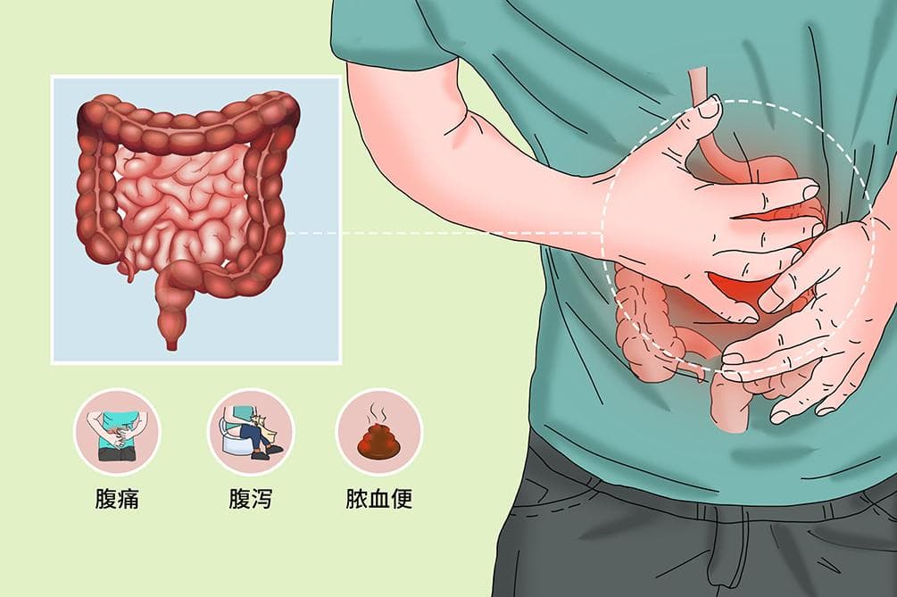 溃疡性结肠炎的症状及治疗