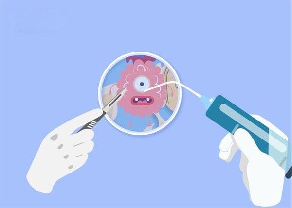 颅底脊索瘤：病因、症状、诊断与治疗全解析