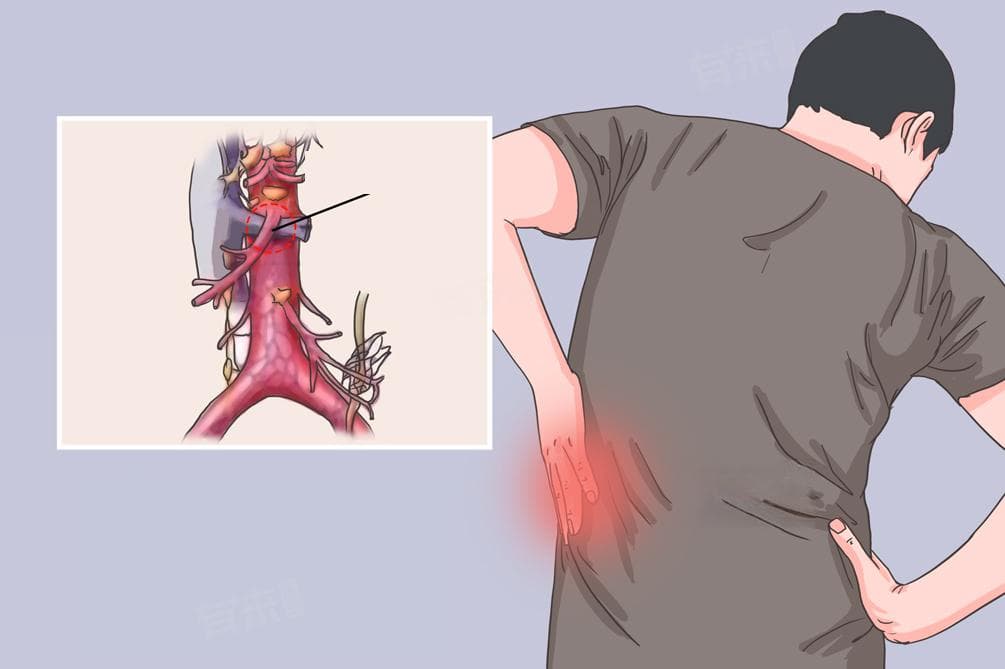 胡桃夹综合征是什么病