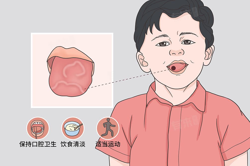 儿童地图舌的原因及治疗方法