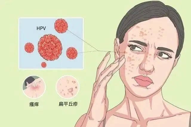 长了扁平疣千万别去抠，小心越抓越多