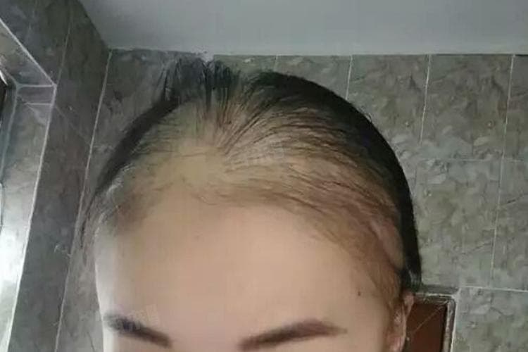化疗为什么会脱发