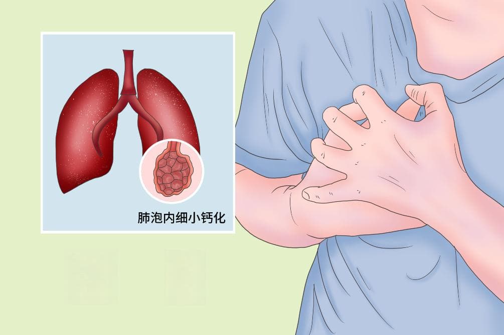 肺泡微石症：罕见肺部疾病的全面解析