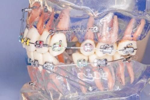 牙床歪斜要打骨钉吗？深入探讨牙床歪斜的矫正方法及打骨钉的重要性
