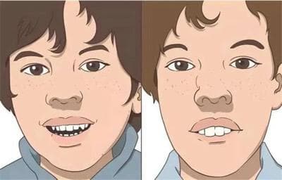 有种丑叫做“腺样体面容”，孩子的这些症状正在提醒你