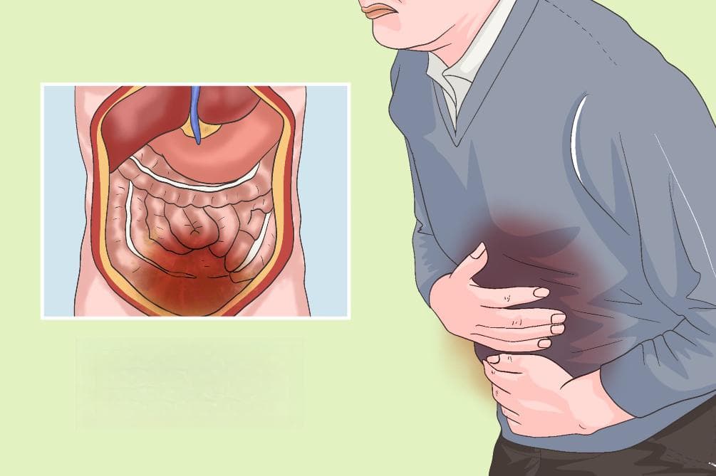 腹膜刺激征：病因、症状与治疗全解析