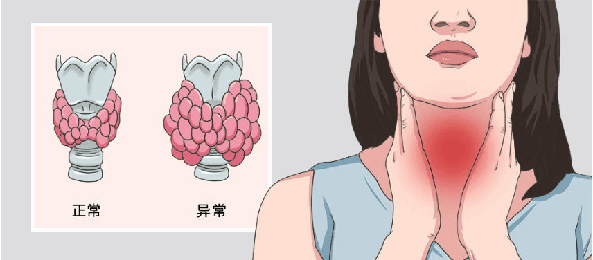 甲状腺双侧叶多发胶质囊肿的形成原因与治疗方法