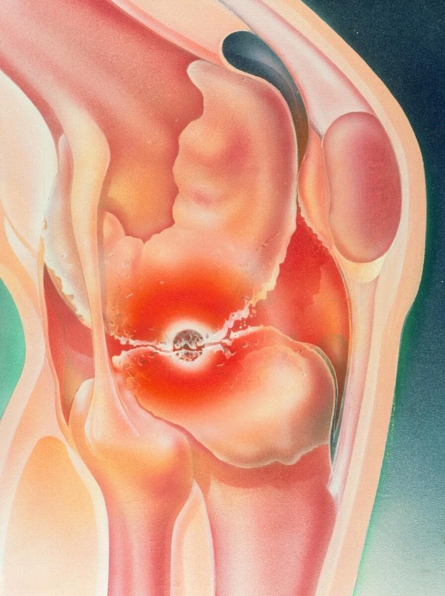 治疗骨关节炎硫酸氨糖与盐酸氨糖、双氯芬酸钠与布洛芬有何不同？