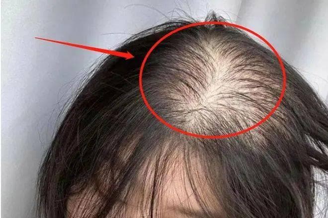 一碗“益肾健脾汤”，治疗脱发效如桴鼓