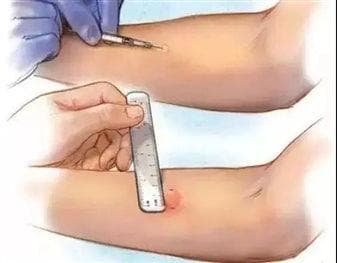 入学体检，结核病筛查不能少