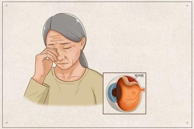 不疼也不痒，容易被忽略，视网膜脱离发生时应如何辨别？