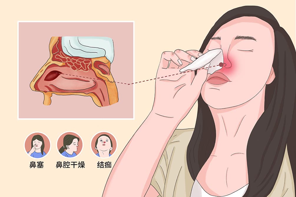 鼻中隔穿孔：病因、症状与治疗全解析