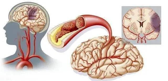 脑梗患者“全素食”健康吗？