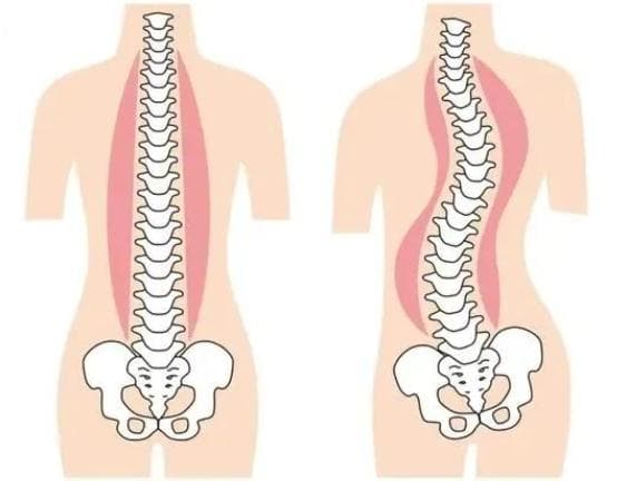 脊柱侧弯全解读：症状、治疗与认知误区指南