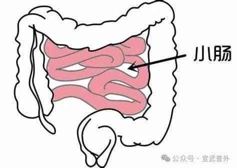 肠梗阻要做手术吗？