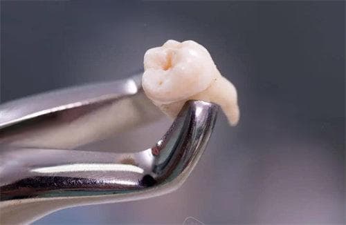 医生说7号牙拔了不用种真的吗?7号牙缺失的真相：不拔影响大，但拔后不一定要种！
