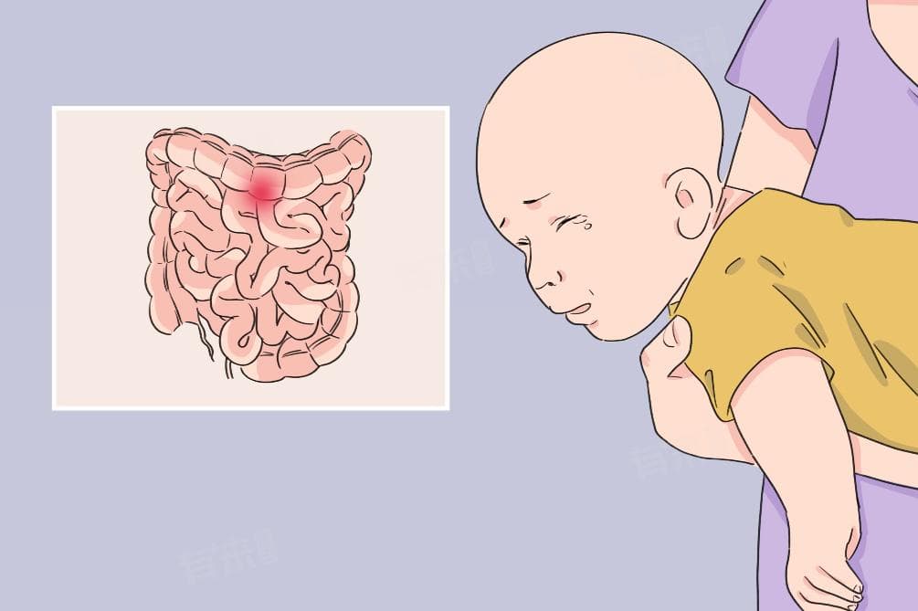 肠痉挛是怎么回事？原因、症状与治疗全解析