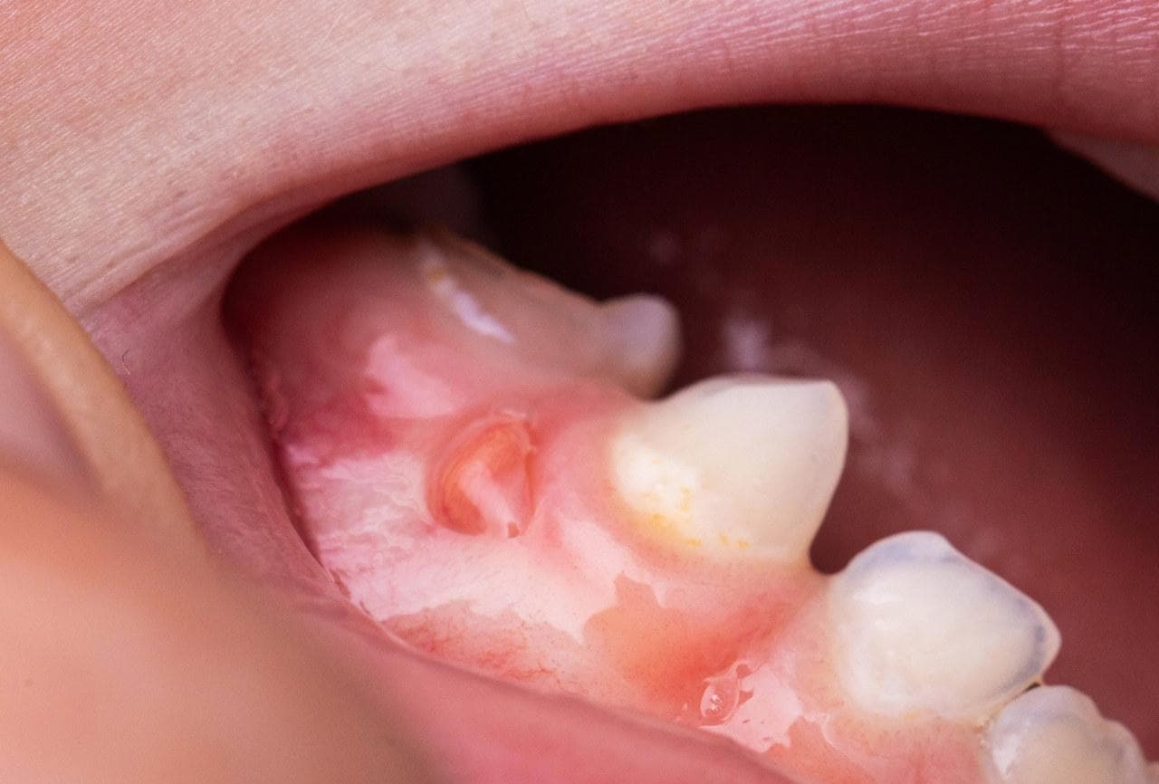 牙龈癌临床症状及防治指南