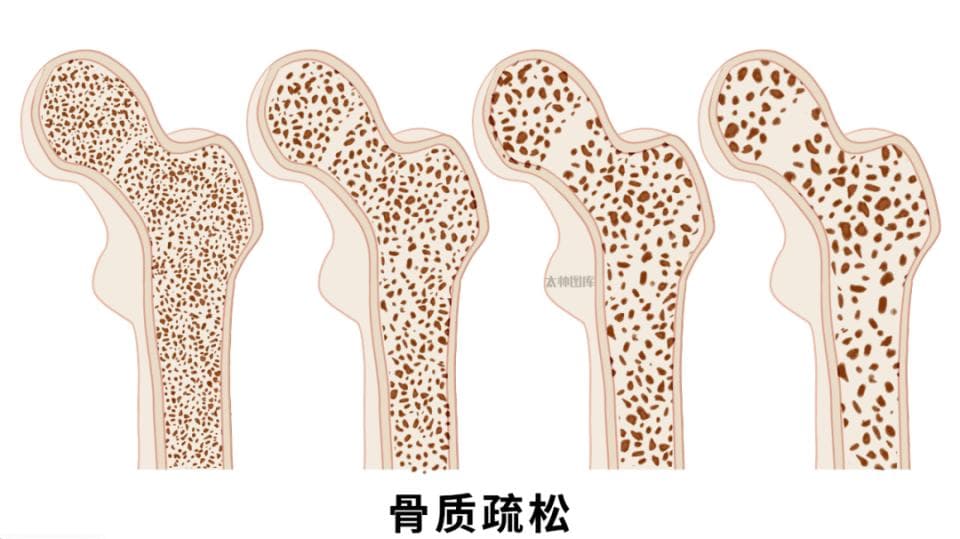 糖与骨的秘密：糖尿病患者为什么容易发生骨质疏松？