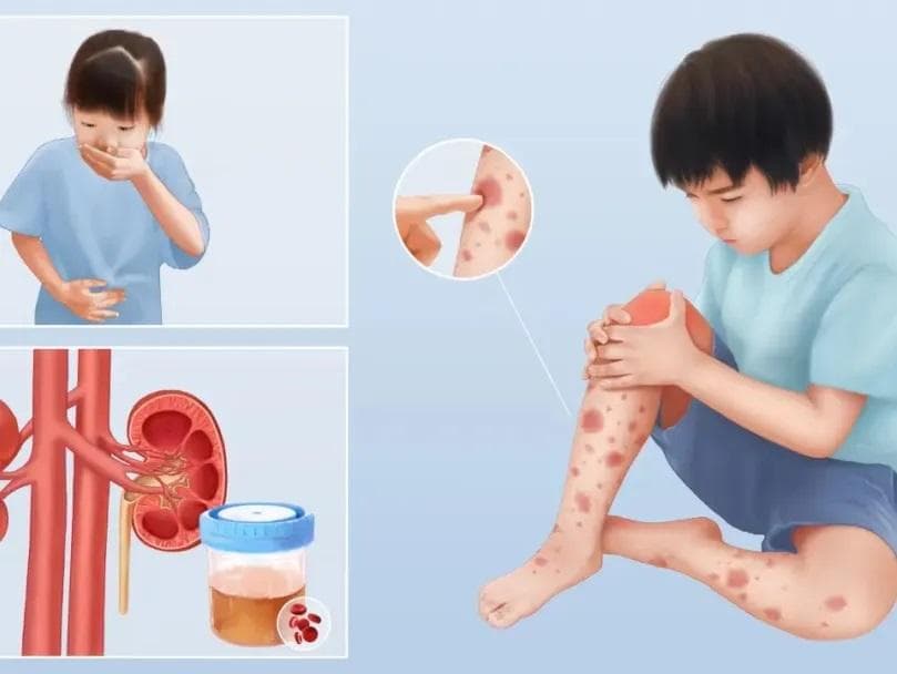 过敏性紫癜：症状、原因与治疗全解析