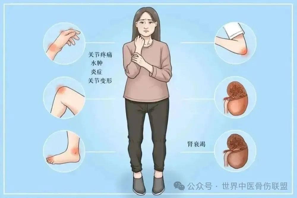 治疗类风湿关节炎，为何需要戒烟？