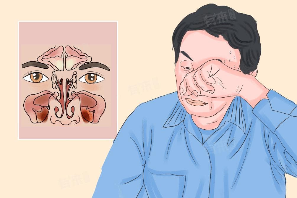 上颌窦炎的治疗方法