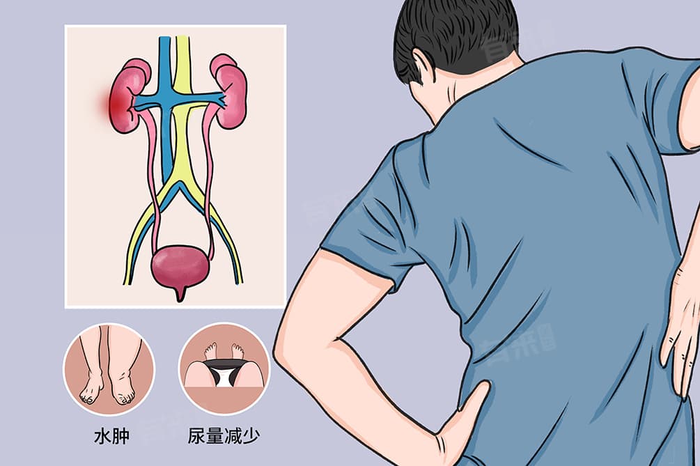 肾病综合征复发的迹象