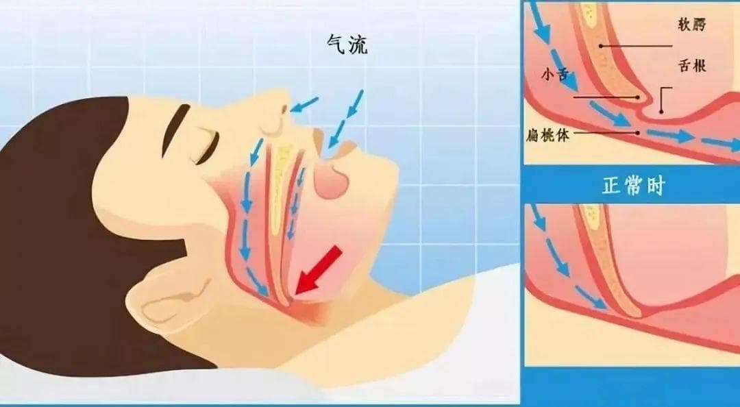 为什么会打呼噜，专家揭秘打鼾的健康真相