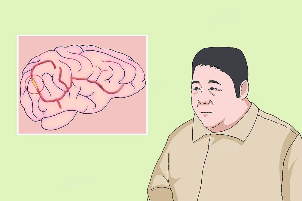 右侧胚胎型大脑后动脉严重吗？一文读懂病情评估标准