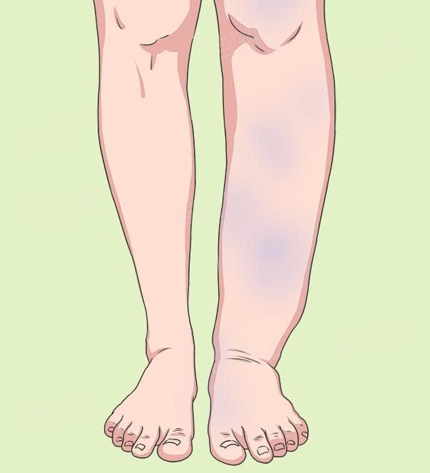 水肿如何分度