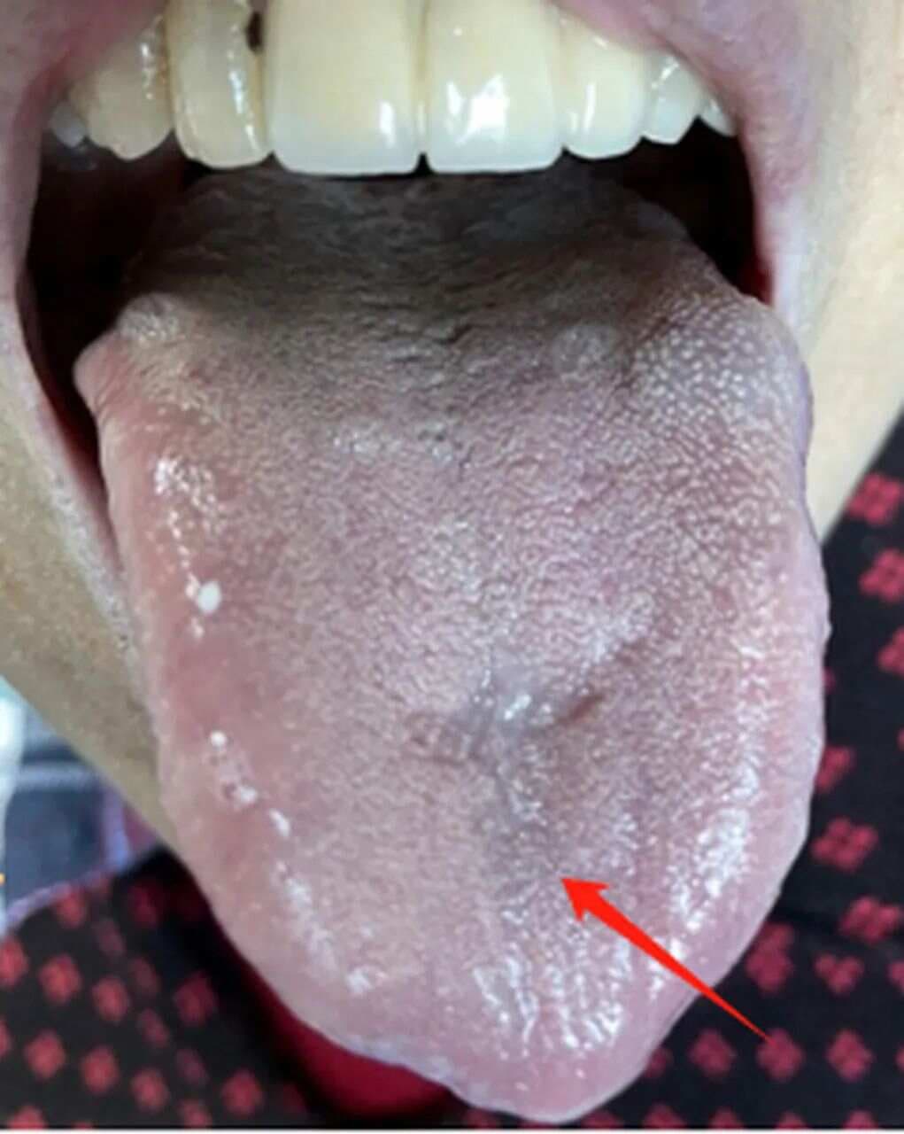 从舌象看少阴病：临床辨病的重要线索