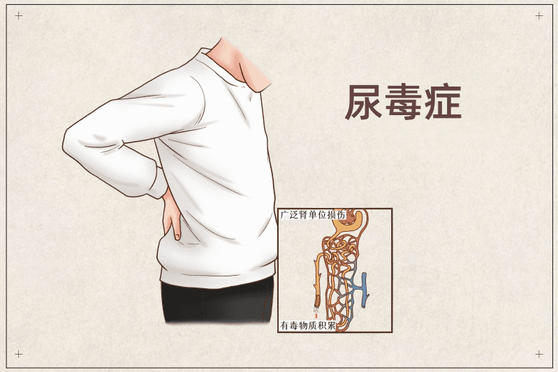停不下来的“手舞足蹈”？ 原来是尿毒症脑病在作祟