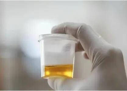 尿量异常怎么判断？如何根据尿量异常情况及时发现肾病？