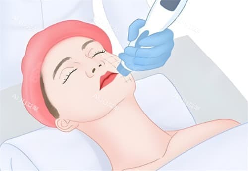 HIFU和热玛吉有什么区别？作用层次不同，抗衰结果各有所长！