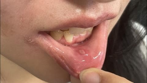 冰硼散可以治疗口腔溃疡吗