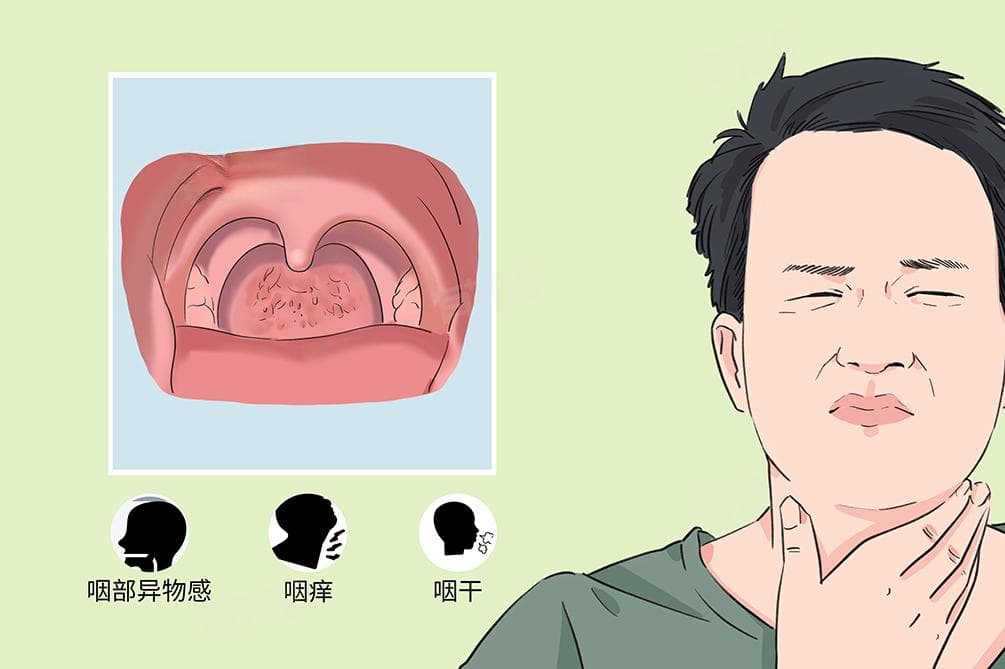 慢性咽炎是怎么引起的？这些诱因需警惕