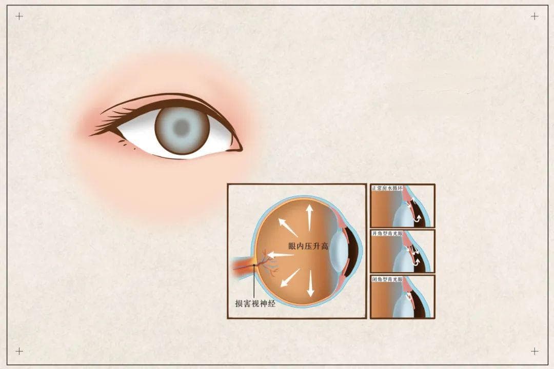 世界青光眼日：为eye筑牢 “防护墙”，守护清晰视界