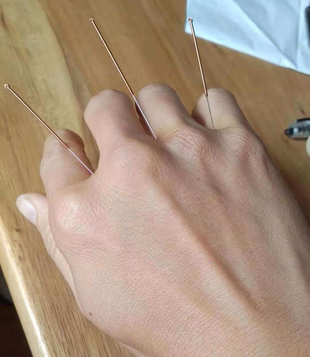 治疗手指麻木的奇穴——三叉穴