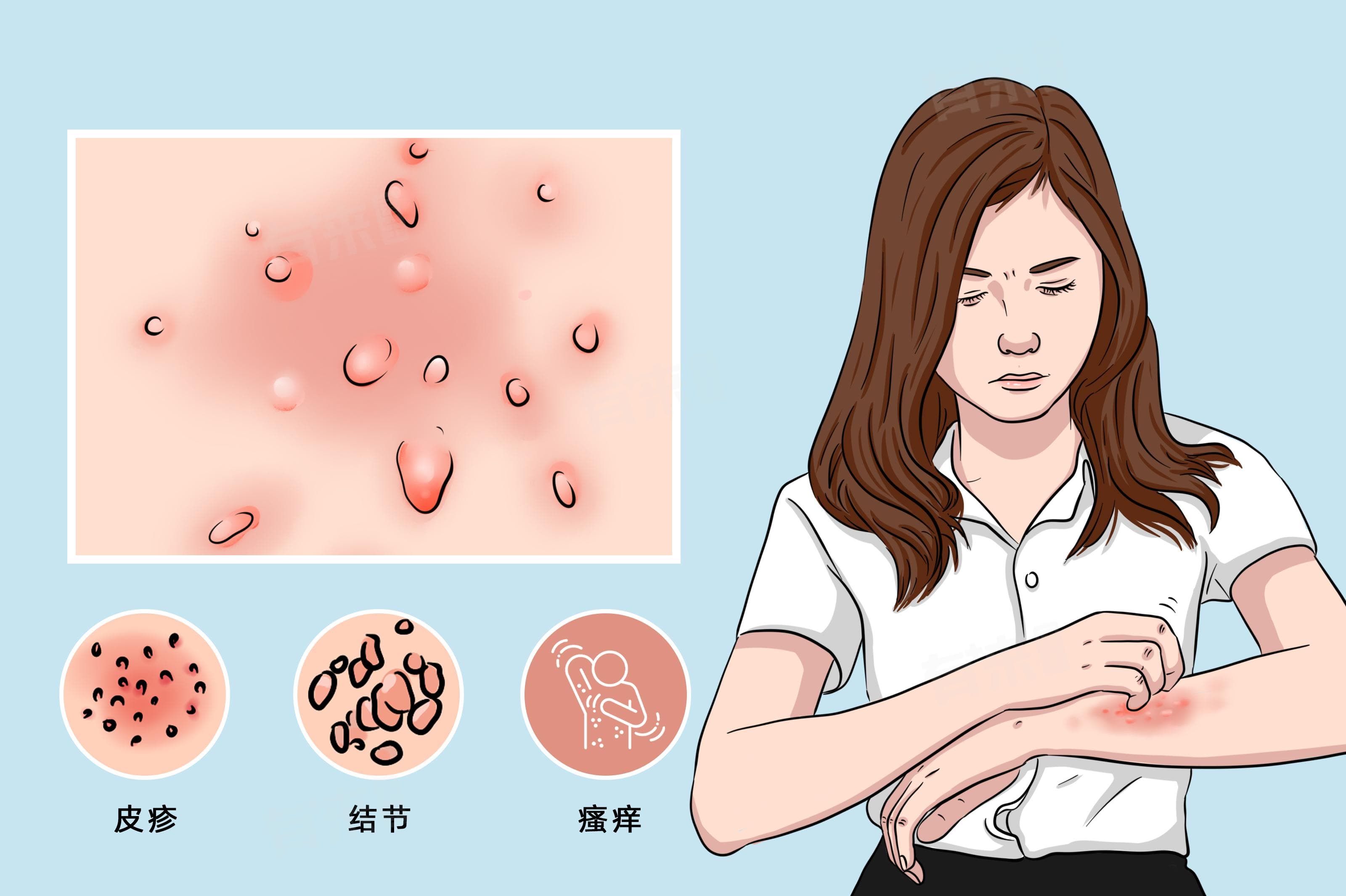 痒疹的图片和症状图片