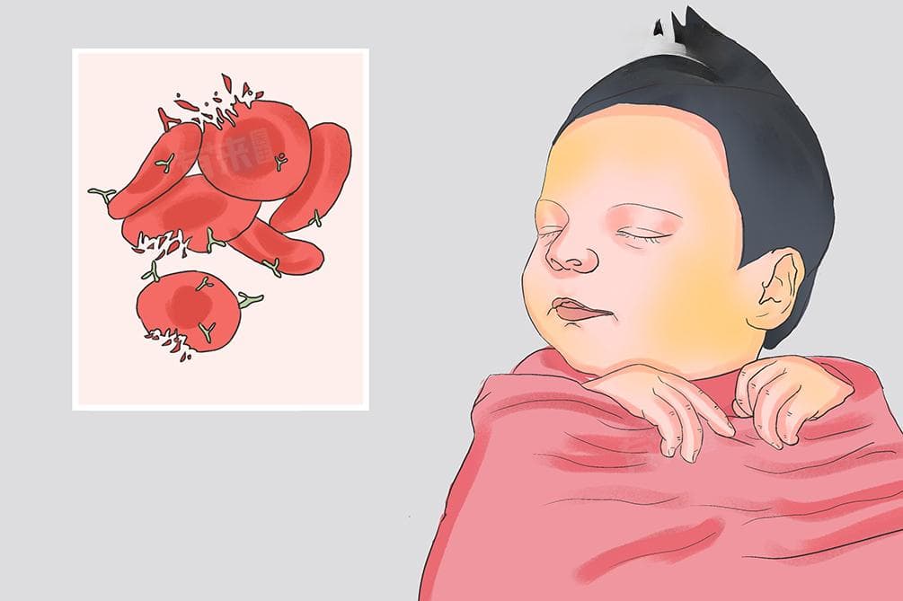 ABO溶血需要怎么治疗
