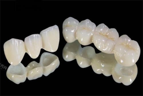 烤瓷冠和全瓷冠哪个更适合前牙修复？分析来看全瓷冠是更优的选择！