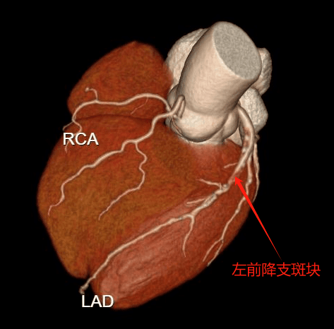 心脏血管病变的“探照灯”——冠状动脉CTA检查