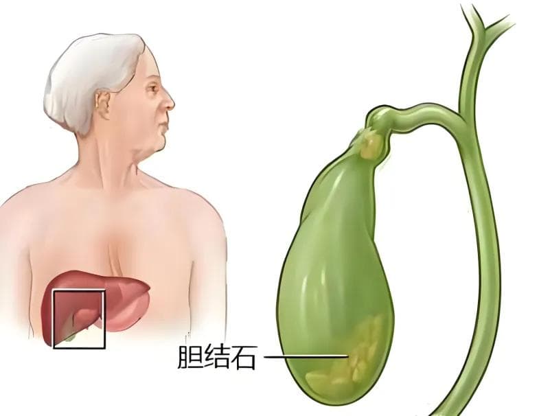要胆识，不要胆石--带你了解胆囊结石