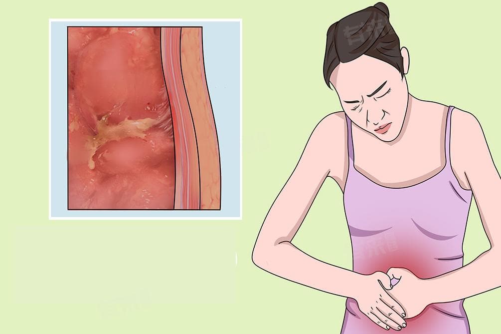 腹膜炎有哪些症状，是怎么引起的