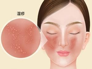 药物过敏起红疹需要忌口吗