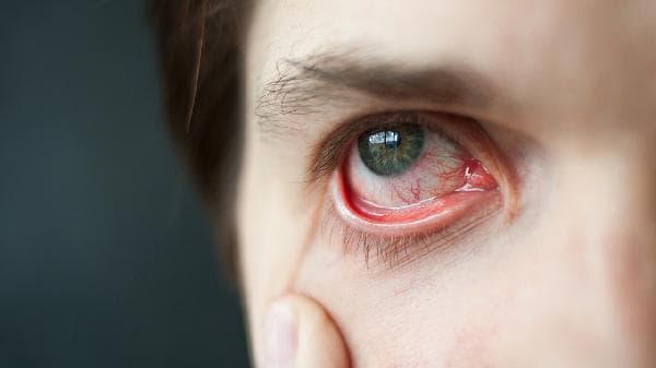 红眼病：症状、预防与治疗全攻略