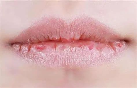 嘴唇干裂脱皮，涂唇膏也不管用？未必是缺水，可能是这种炎症→