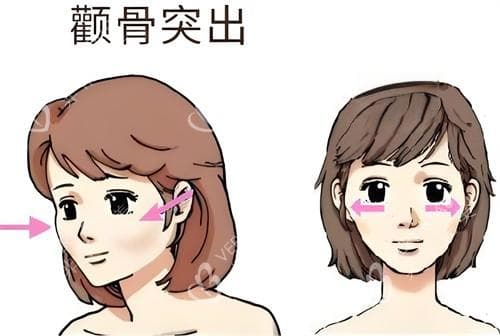 颧骨突出怎么缩小？手术、填充、化妆都有招，看过来！