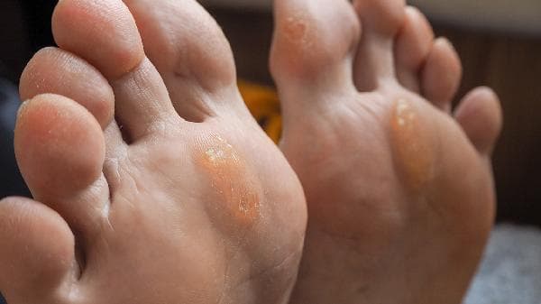 儿童先天性扁平足可以矫正吗