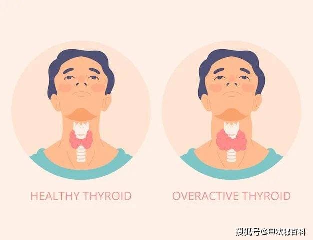 甲亢用药治疗为何疗程比较长？如何进行药物治疗